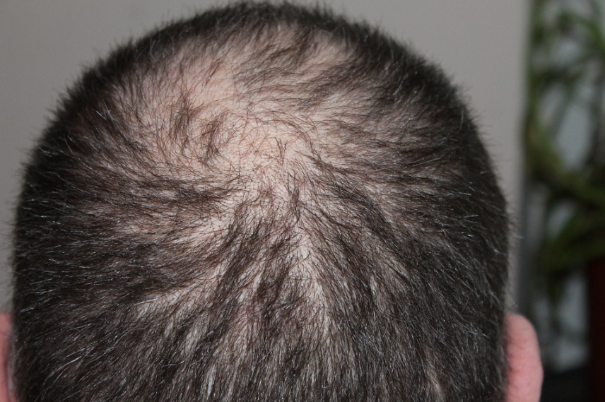 How to Thicken Hair Without Medication post thumbnail image
